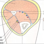 【ランナー必見】コンパートメント症候群かもしれない。