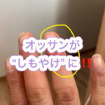 ”しもやけ”になった時の対処方法。